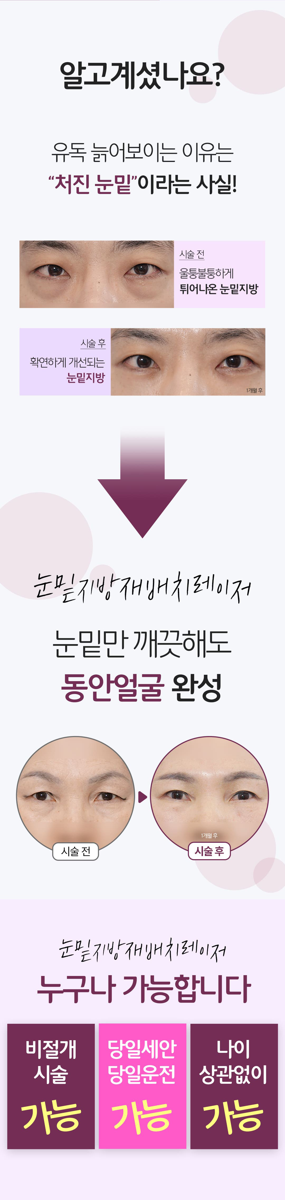 눈밑지방레이저 상세 설명