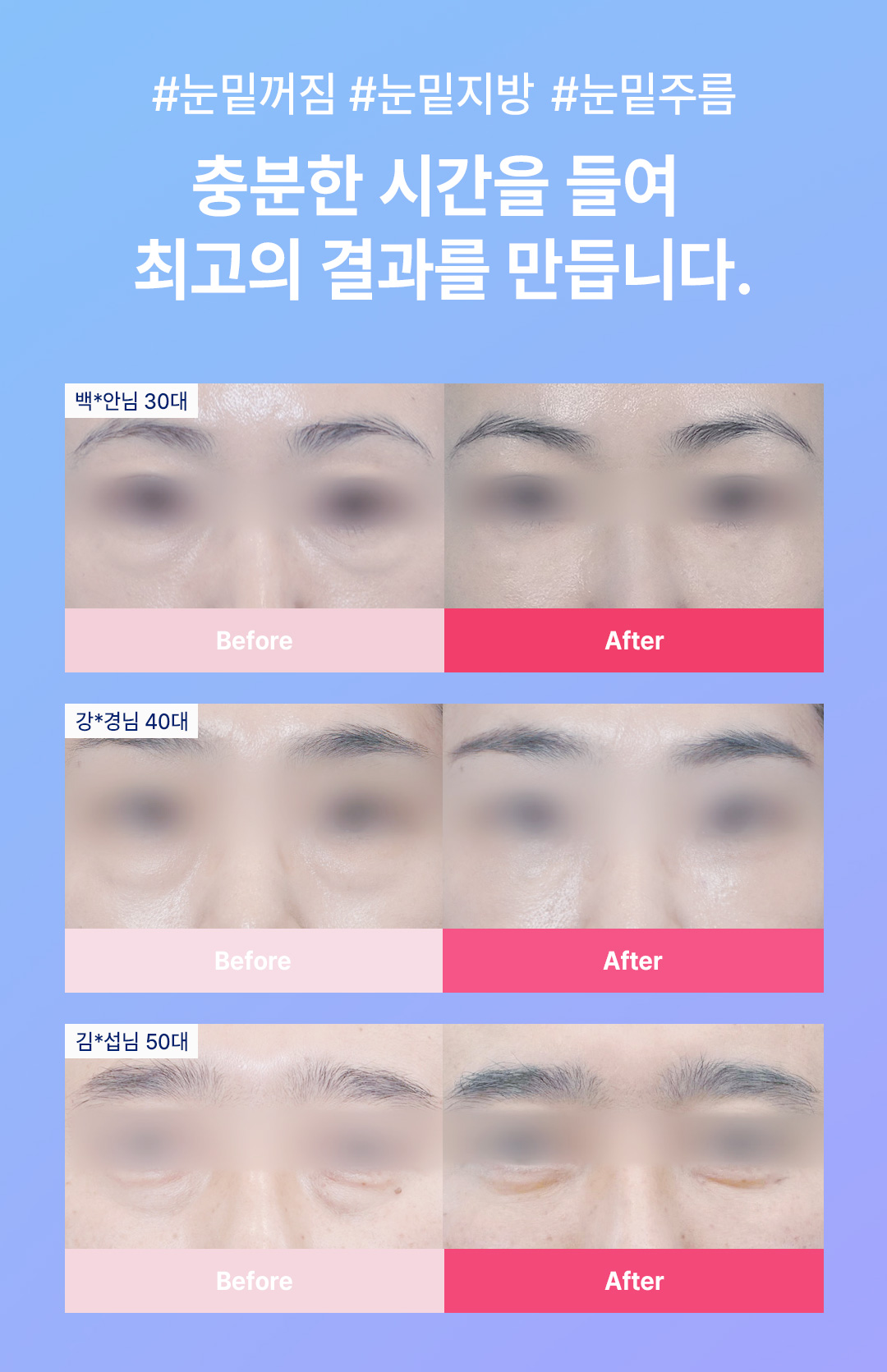 눈밑지방재배치 이벤트 안내