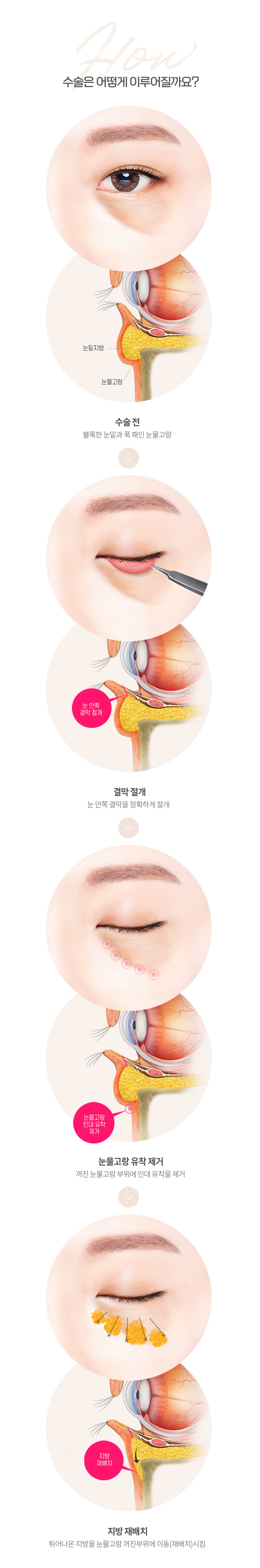 눈밑지방재배치 이벤트 안내